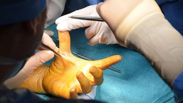 doigt a ressaut traitement kine doigt a ressaut operation doigt à ressaut chirurgie docteur laurent thomsen chirurgien main paris chirurgien poignet paris clinique drouot 1
