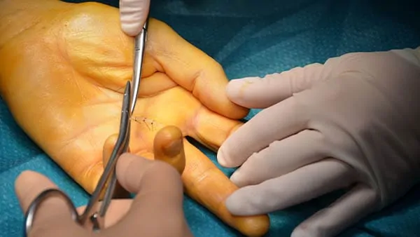 doigt a ressaut traitement kine doigt a ressaut operation doigt à ressaut chirurgie docteur laurent thomsen chirurgien main paris chirurgien poignet paris clinique drouot 3