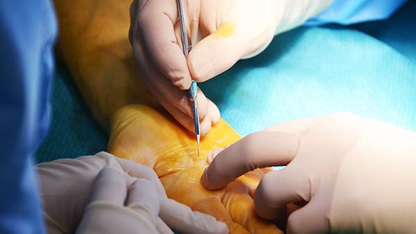 dupuytren maladie de dupuytren hopital dupuytren doigt dupuytren chirurgien dr thomsen clinique drouot