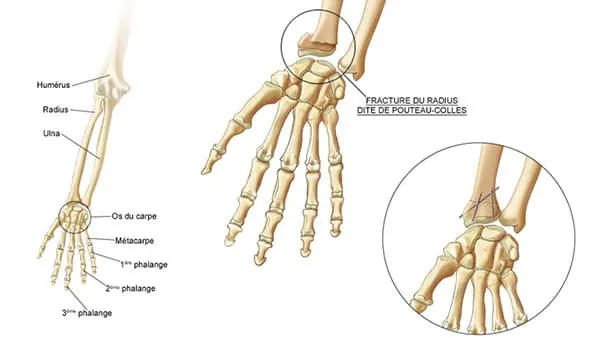 fracture du poignet fracture ouverte poignet fracture poignet symptome docteur laurent thomsen chirurgien main paris chirurgien poignet paris clinique drouot 1