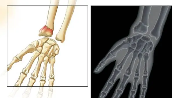 fracture du poignet fracture ouverte poignet fracture poignet symptome docteur laurent thomsen chirurgien main paris chirurgien poignet paris clinique drouot 2