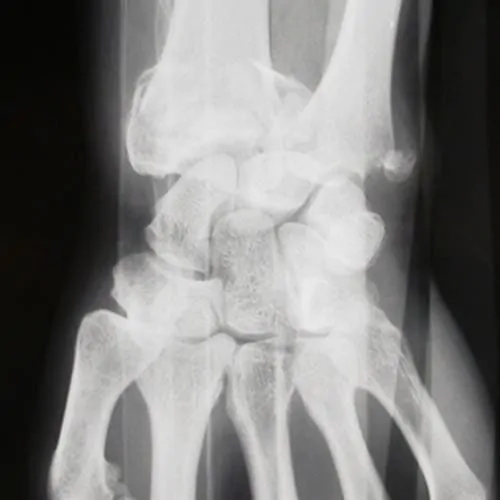 fracture du poignet fracture ouverte poignet fracture poignet symptome docteur laurent thomsen chirurgien main paris chirurgien poignet paris clinique drouot 3