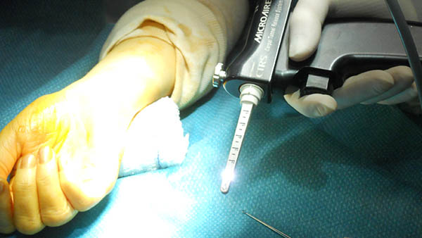 syndrome du canal carpien operation canal carpien traitement docteur laurent thomsen chirurgien main paris chirurgien poignet paris clinique drouot 1