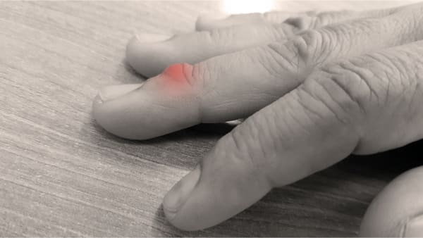 Comment soigner un kyste mucoide au doigt ?