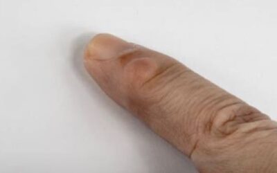 Kyste mucoide doigt traitement