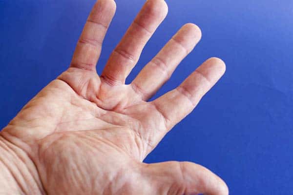 operation dupuytren mains ratee douleur maladie de dupuytren mains exercices dr laurent thomsen chirurgien main paris chirurgien poignet paris clinique drouot