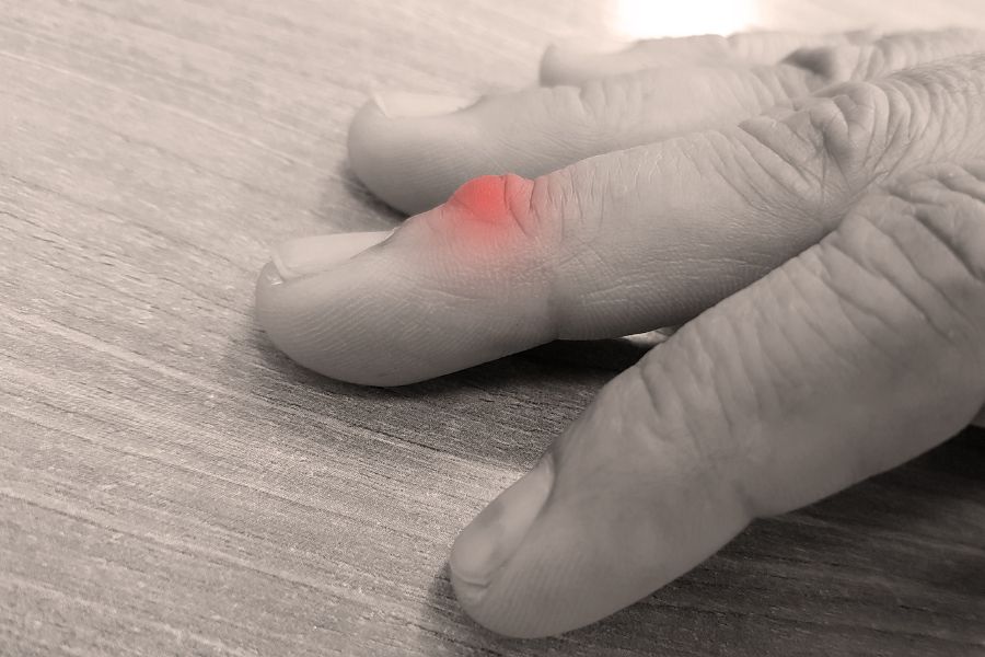 Tumeur glomique au doigt : pourquoi faire un IRM ?